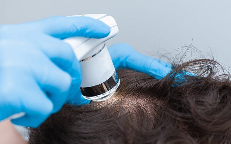 Samsun’da Saç Dökülmesine Son: Daha Gür ve Güçlü Saçlar İçin 